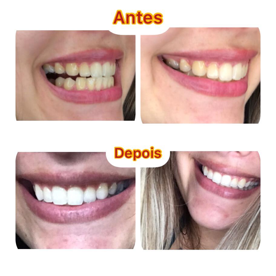 CLAREAMENTO DENTAL NOTURNO (ou CASEIRO) – 7 passos da técnica. Veja o Antes e Depois